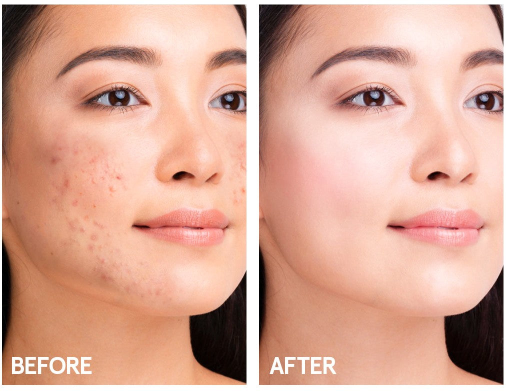 Before and after: skin with acne marks, then clearer skin
